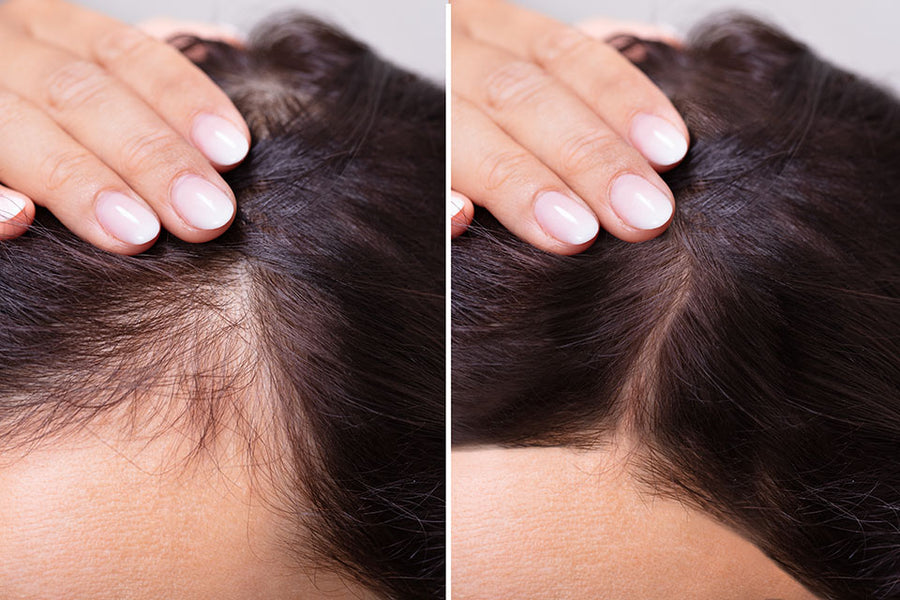 Laser vs LED in Hair Loss Treatment